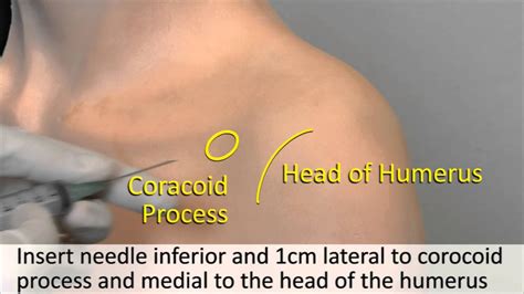 Musculoskeletal Examination And Joint Injection Series Shoulder Joint