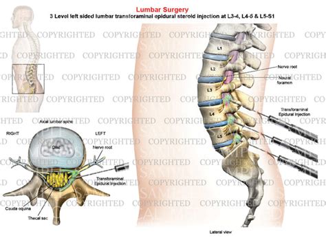 3 Level - Left-side lumbar Transforaminal Epidural Injection - Male ...