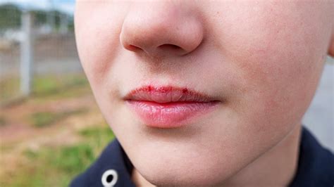 How To Treat Windburn Dry And Chapped Lips In Kids The Chronicle