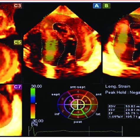 Ecocardiograma Transtor Cico Tridimensional Em Tempo Real Proje O