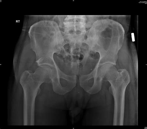 Acetabular Reconstruction