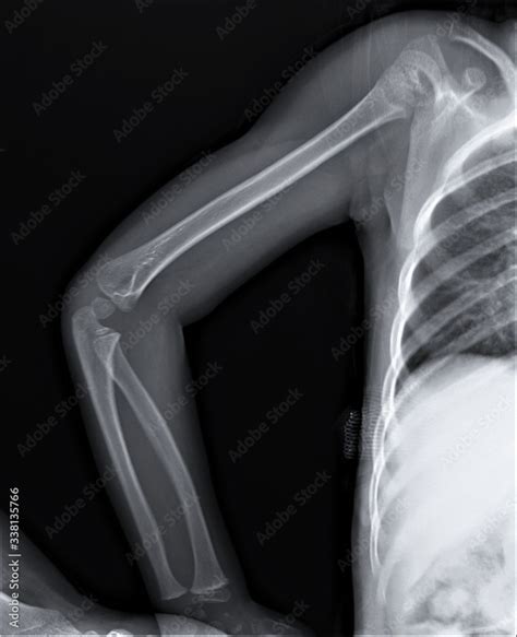 x-ray of the forearm and shoulder bones with the elbow joint Stock Photo | Adobe Stock