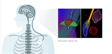 Kurswechsel Tiefe Hirnstimulation Boston Scientific