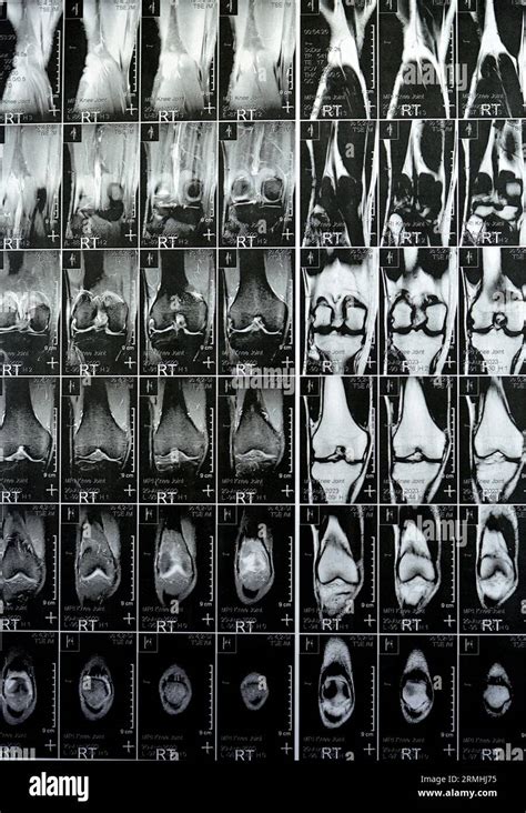 Mri Of The Right Knee Showing Mild Joint Effusion With Normal Other