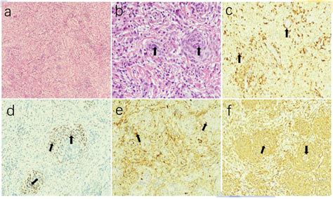 A Rare Lymphoplasmacyte Rich Meningioma Involving The Dura Of The Skull