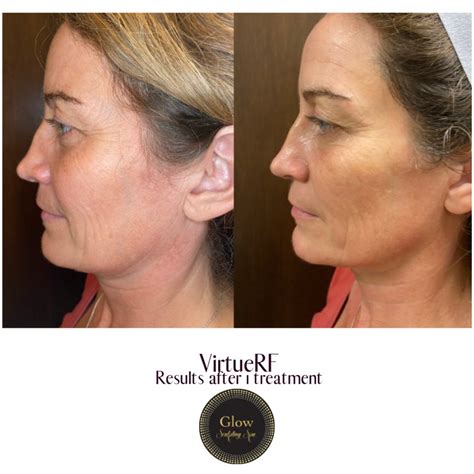 Skin Rejuvenation Tightening Virtue Rf Glow Laser Aesthetics