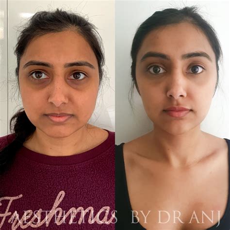 Dr Anjuli Patel Aesthetics By Dr Anj