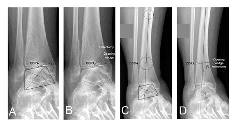 Distal Tibial Osteotomy