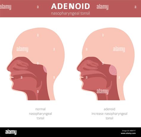 Nasal And Throat Nasopharynx Diseases Adenoids Diagnosis And