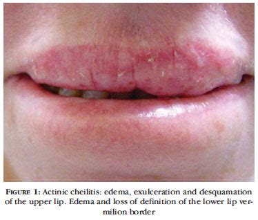 Squamous Cell Carcinoma Lip