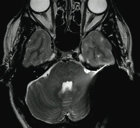 Cochlear implants MR safety - Questions and Answers in MRI