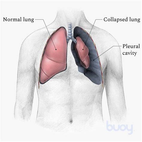 Lung Surgery For Collapsed Lung