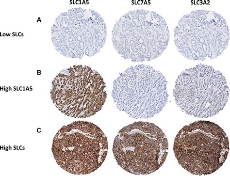 Slc Protein Expression In Invasive Breast Cancer Cores A Low Slc