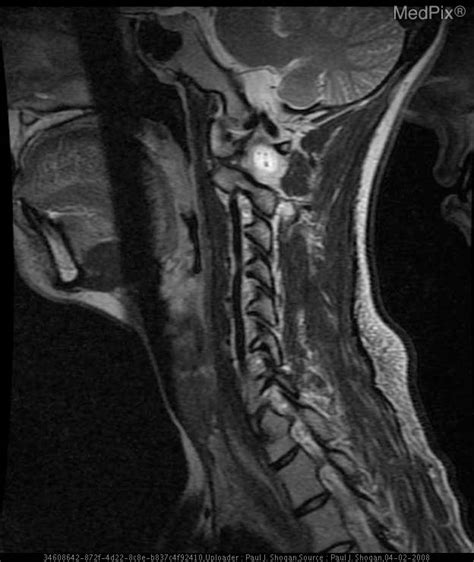 Vertebral Artery Dissection Mri