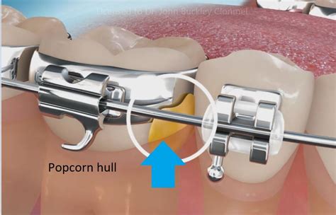 Popcorn And Orthodontic Treatment Clonmel Orthodontics