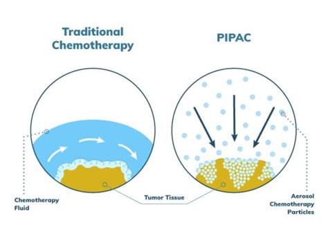 PIPAC for Mesothelioma | Treatment & Side Effects