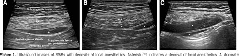 Figure From Complications And Technical Consideration Of Ultrasound