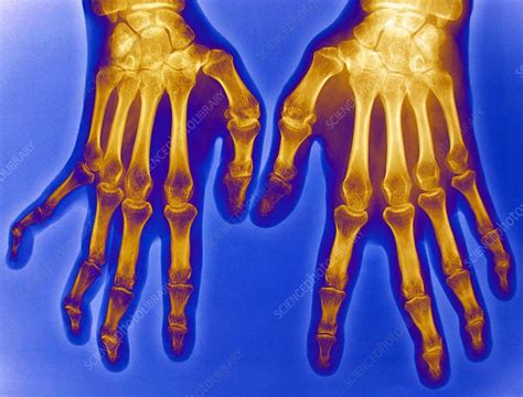 Lupus, X-ray - Stock Image - C021/3615 - Science Photo Library