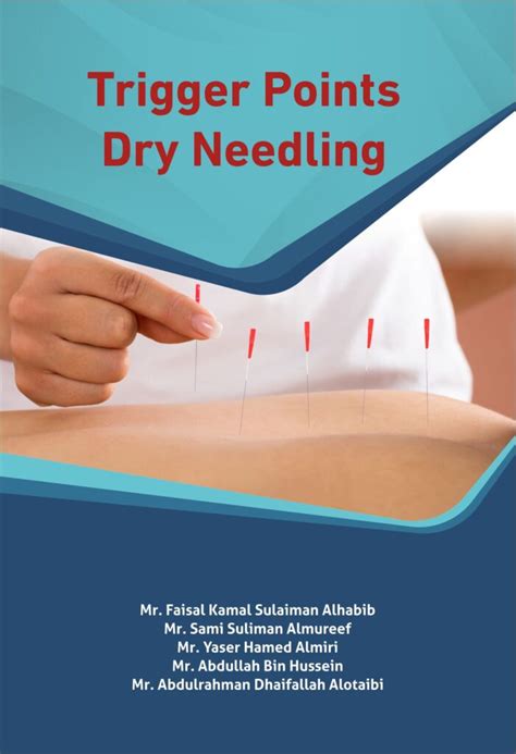 Trigger Points Dry Needling Horizon Books