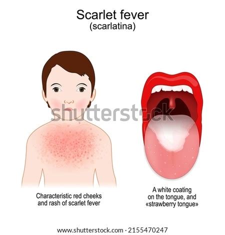 SYMPTOMS-OF-SCARLET-FEVER Stock Vector Images - Avopix.com