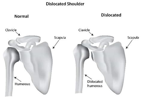 Arthroscopic Shoulder Stabilization Chillicothe Oh Shoulder Surgery