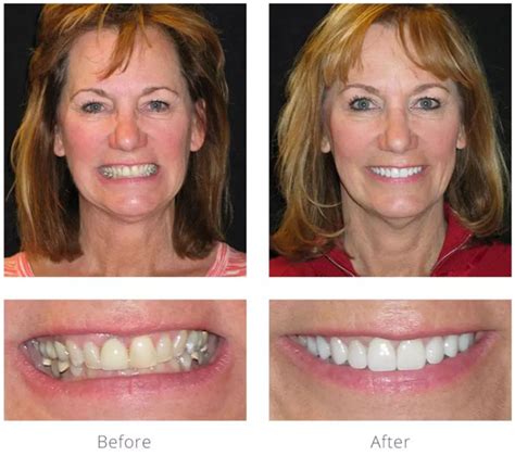 Front Tooth Root Canal Before And After