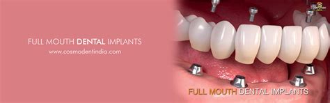 Full Mouth Dental Implants Treatment And Cost In India Cosmodent India