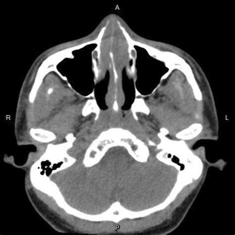 Nasal Septal Abscess A 10 Year Retrospective Study Request Pdf