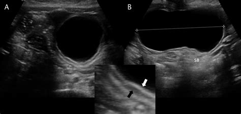 Enteric Duplication Cyst A 3 Month Old Girl With Palpable Mass In The