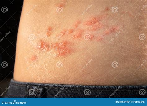 Mild Shingles On Stomach