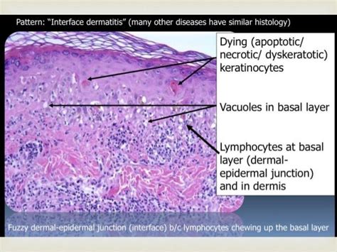 Erythema Multiforme Steven Johnson Syndrome And Toxic Epidermal Necr