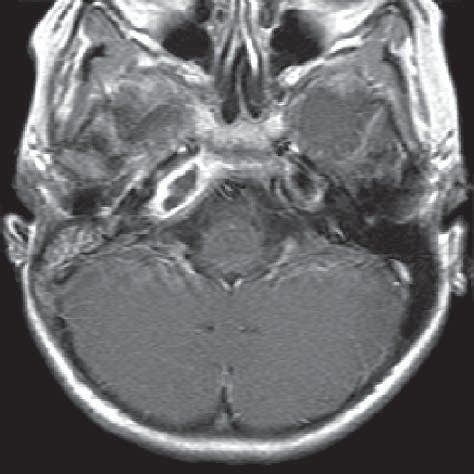 [PDF] Radiology quiz case 2. Gradenigo syndrome caused by right petrous ...