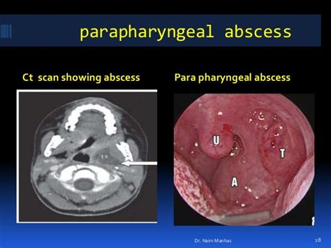 pharyngeal abscess pictures intern ultrasound   month
