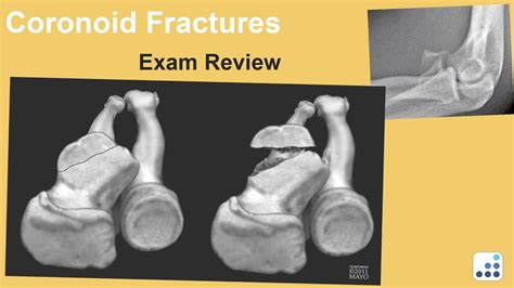 Coronoid Fractures Exam Review Mark S Cohen Md Youtube