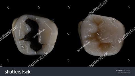 Amalgam Filling Replacement Composite Stock Photo 1092211787 | Shutterstock