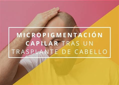 Micropigmentación del cuero cabelludo tras un trasplante capilar