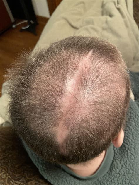 After surgery, radiation, and chemo my hair is attempting to grow back