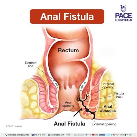 Anal Fistula Symptoms Causes Types Complications Prevention