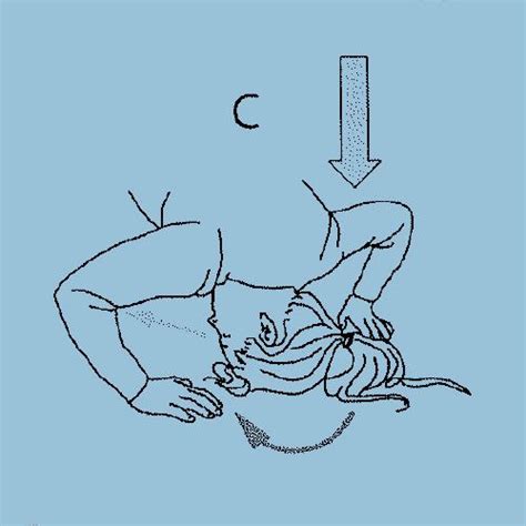 Half Somersault Or Foster Maneuver A Diy Home Exercise For Vertigo