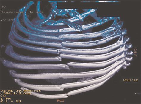 Three Dimensional CT Reconstruction Demonstrating Flail Chest With 9