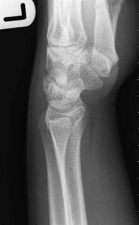 X Ray Wrist Lateral View