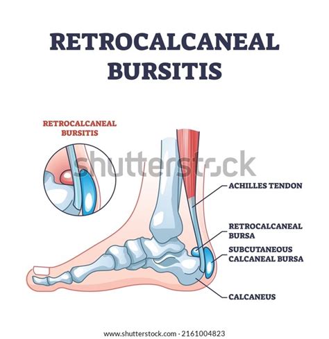 Subcutaneous Calcaneal Bursitis