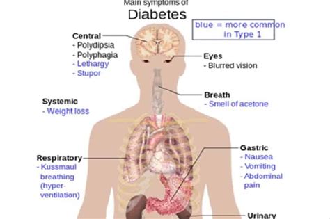 The Diabetes Hypothesis Follows A Historical View Of Sugar