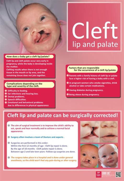 Cleft Lip And Palate Eng Dp 131 Smart Doc Posters