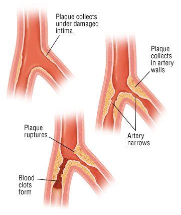 Atherosclerosis Guide: Causes, Symptoms and Treatment Options