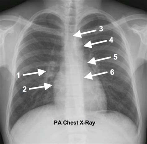 Cpr Radiographs Flashcards Quizlet