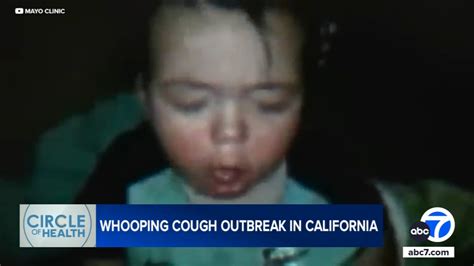 What are the symptoms of whooping cough? As whooping cough cases surge nationwide, outbreak ...