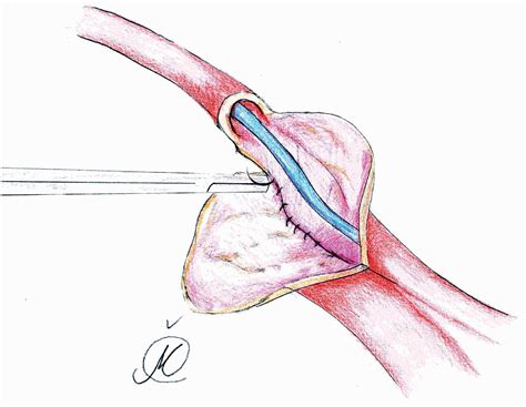 Scielo Brasil Modified Wallace Anastomotic Technique Reduces