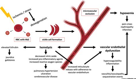 Manifestations Of Sickle Cell Disorder At Abdominal And Pelvic Imaging