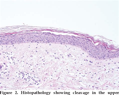 Figure 1 From Staphylococcal Scalded Skin Syndrome Mimicking Toxic